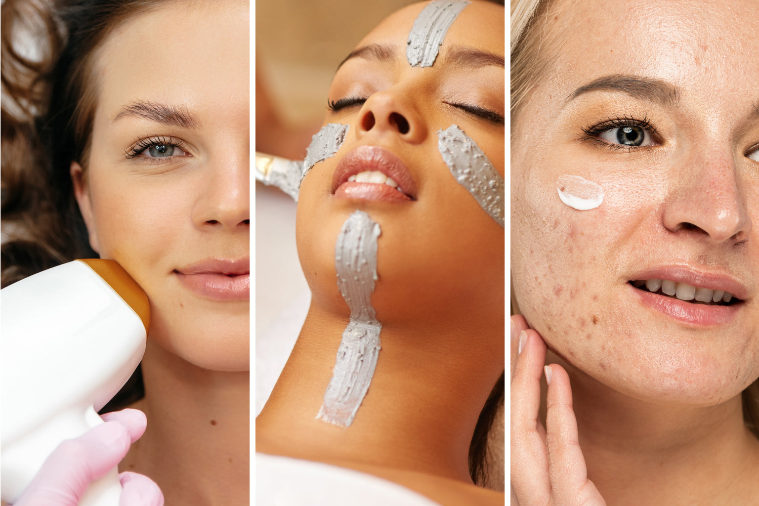 Acné adulte : pourquoi vos crèmes ne fonctionnent plus (et quoi faire à la place)