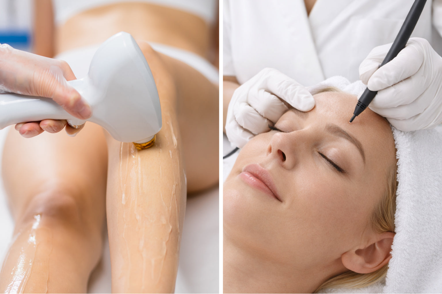 Épilation laser vs Électrolyse : laquelle choisir en 2026 ?