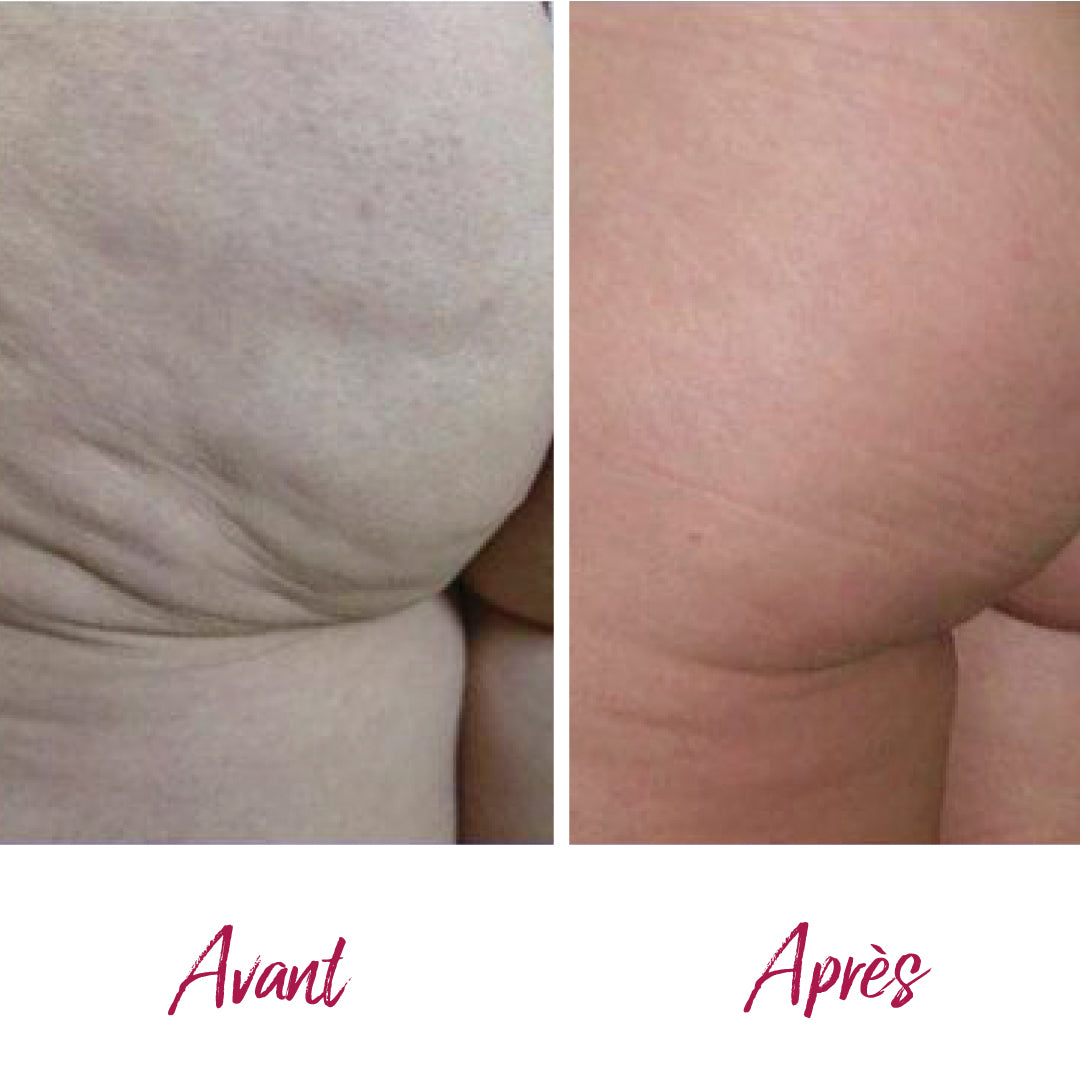 Traitement anti-cellulite, soin raffermissant ou remodelage corporel avec radiofréquence