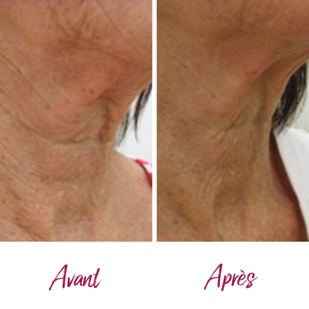 Lifting NIR infrarouge : visage, cou et décolleté