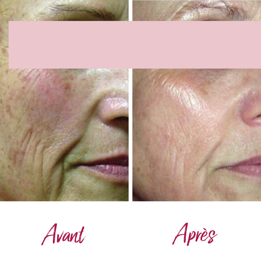 Lifting NIR infrarouge : visage, cou et décolleté